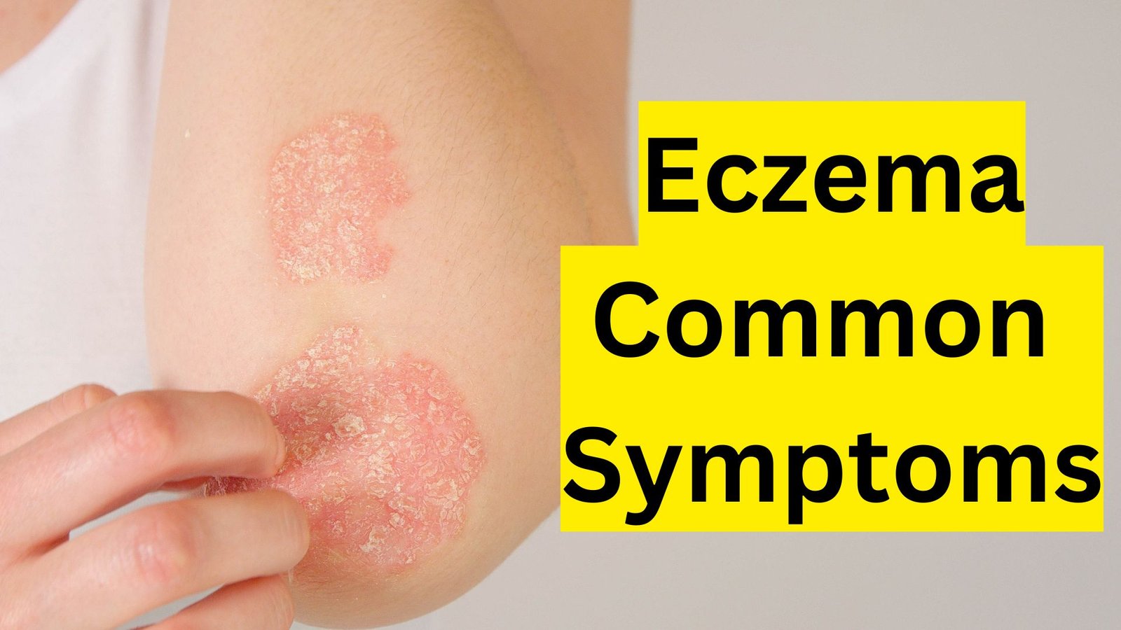 eczema common symptoms